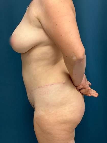 Tummy Tuck Before & After Patient #271