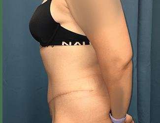 Tummy Tuck Before & After Patient #457