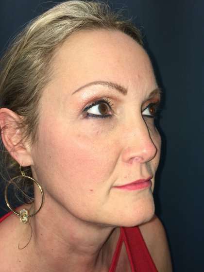 Blepharoplasty Before & After Patient #2437