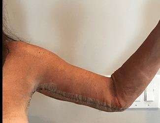 Arm Lift Before & After Patient #2461
