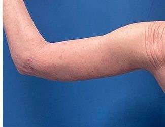 Arm Lift Before & After Patient #2473