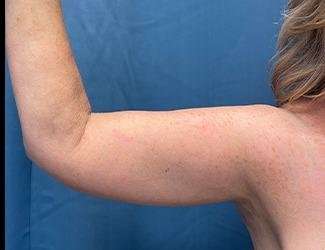 Arm Lift Before & After Patient #2482