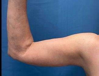 Arm Lift Before & After Patient #2491