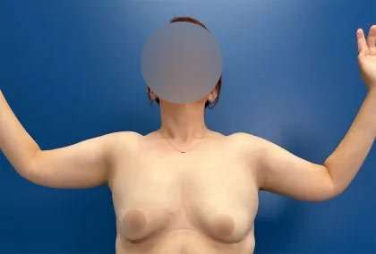 Arm Lift Before & After Patient #2498
