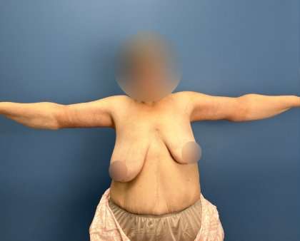 Arm Lift Before & After Patient #2503