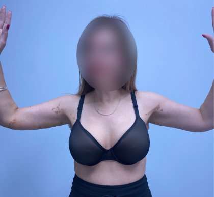 Arm Lift Before & After Patient #2508