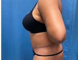 Tummy Tuck Before & After Patient #468