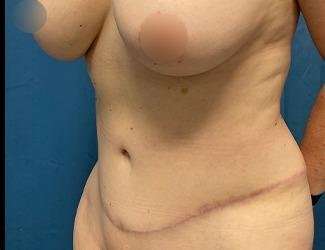 Tummy Tuck Before & After Patient #475
