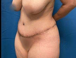 Tummy Tuck Before & After Patient #493