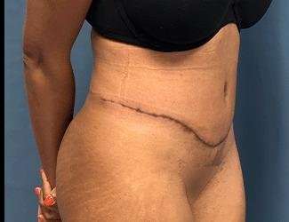 Tummy Tuck Before & After Patient #504