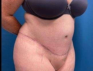 Tummy Tuck Before & After Patient #515