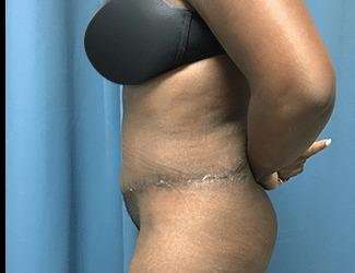 Tummy Tuck Before & After Patient #528