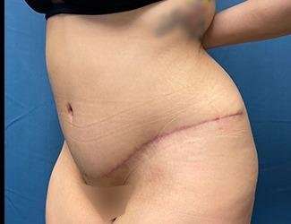 Tummy Tuck Before & After Patient #535