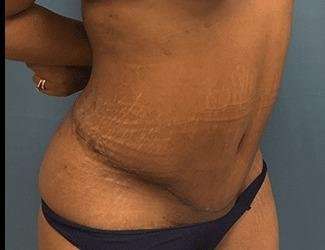 Tummy Tuck Before & After Patient #546