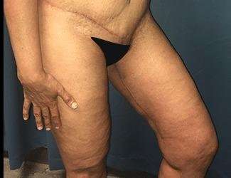 Thigh Lift Before & After Patient #558