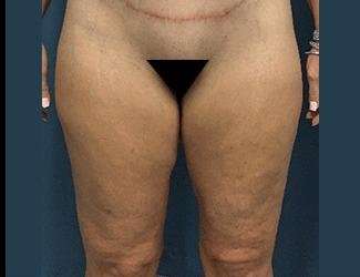 Thigh Lift Before & After Patient #563