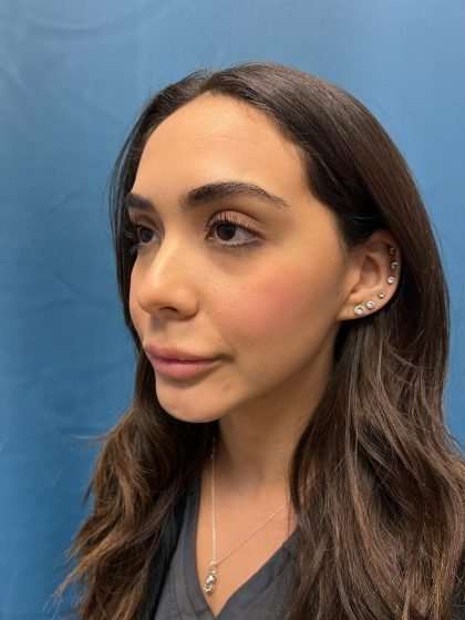 Submentoplasty Before & After Patient #597