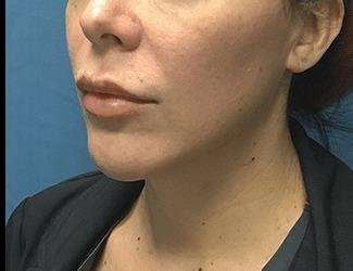 Submentoplasty Before & After Patient #621