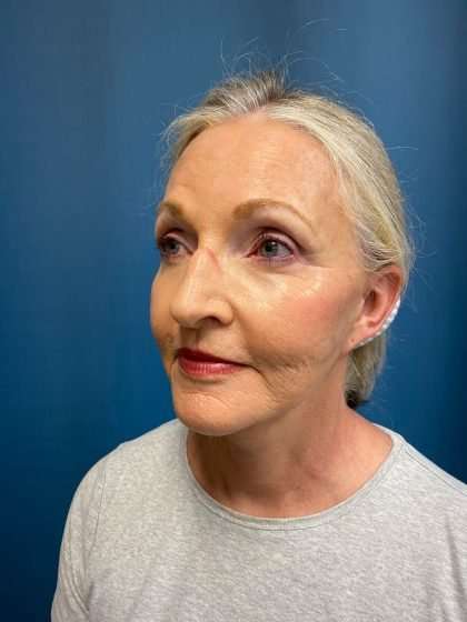 Submentoplasty Before & After Patient #654
