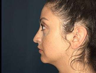Rhinoplasty Before & After Patient #680