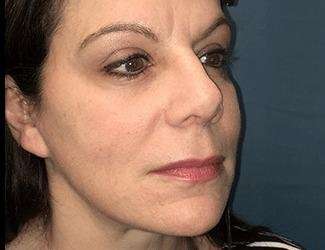Rhinoplasty Before & After Patient #693