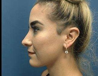 Rhinoplasty Before & After Patient #706