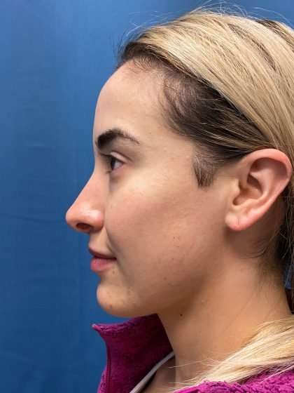 Rhinoplasty Before & After Patient #715