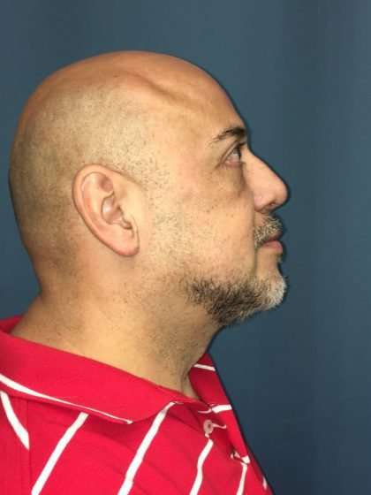 Rhinoplasty Before & After Patient #722