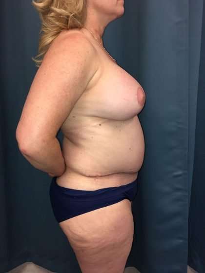 Mommy Makeover Before & After Patient #882