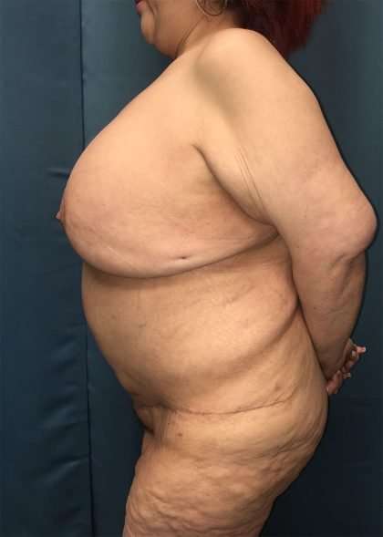 Mommy Makeover Before & After Patient #893
