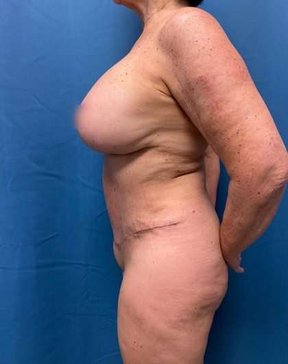 Tummy Tuck Before & After Patient #311