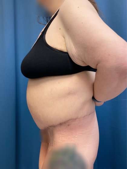 Massive Weight Loss Before & After Patient #986