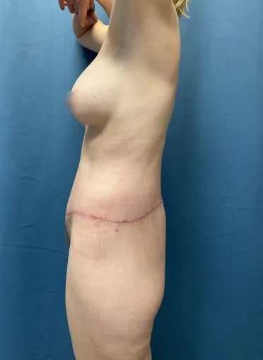 Lower Body Lift Before & After Patient #1034