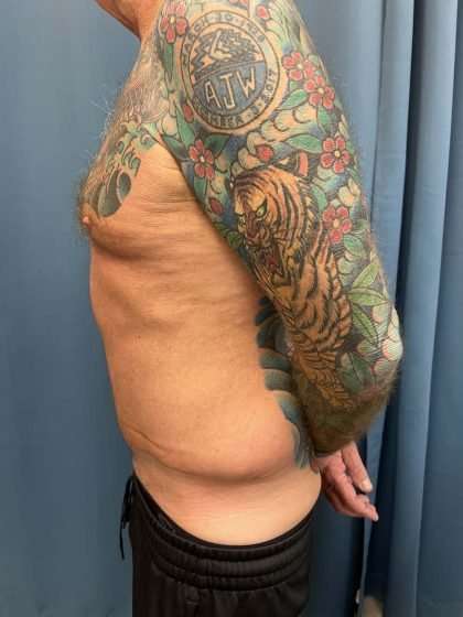 Tummy Tuck Before & After Patient #322