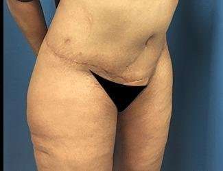 Lower Body Lift Before & After Patient #1047