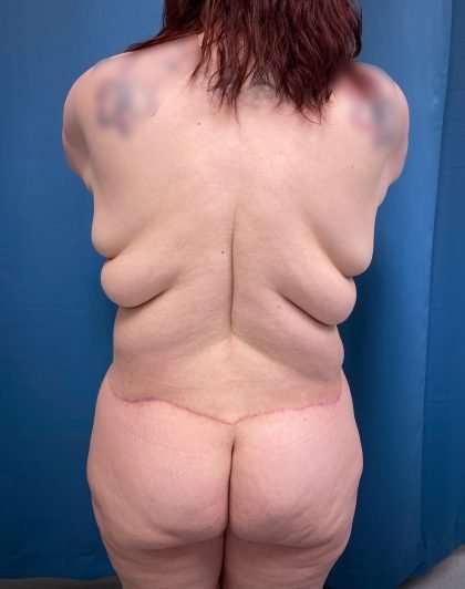 Lower Body Lift Before & After Patient #1072