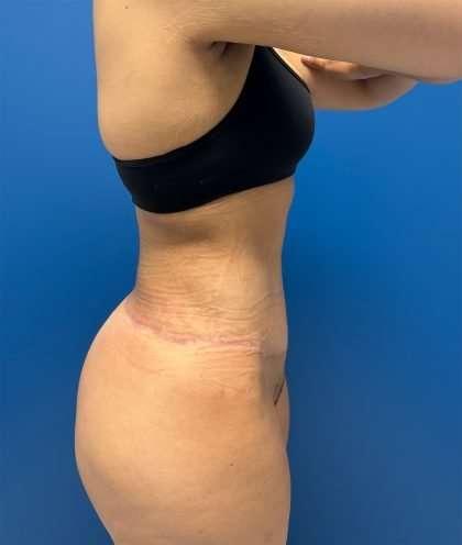 Lower Body Lift Before & After Patient #1081