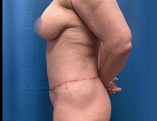 Lower Body Lift Before & After Patient #1094