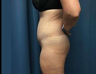 Lower Body Lift Before & After Patient #1114