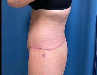 Lower Body Lift Before & After Patient #1127