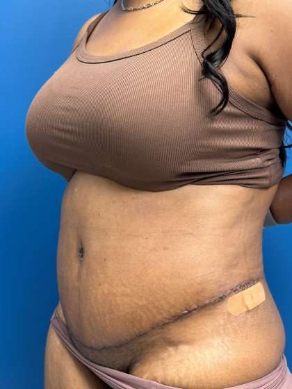 Lower Body Lift Before & After Patient #1154