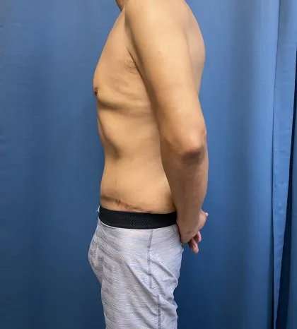 Tummy Tuck Before & After Patient #333