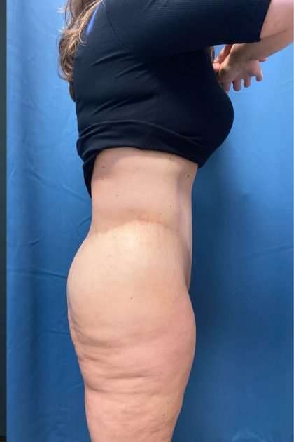 Lower Body Lift Before & After Patient #1174