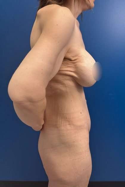 Lower Body Lift Before & After Patient #1187