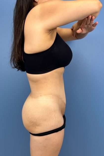 Lower Body Lift Before & After Patient #1213