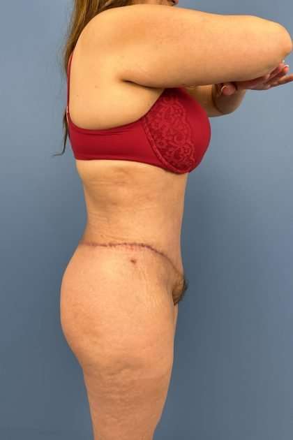 Lower Body Lift Before & After Patient #1226