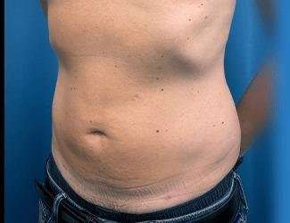 Liposuction Before & After Patient #1257