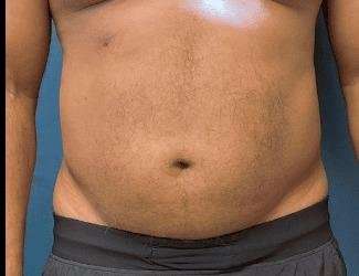 Liposuction Before & After Patient #1262