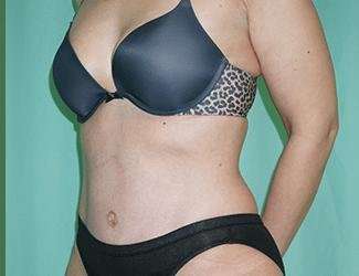 Tummy Tuck Before & After Patient #340