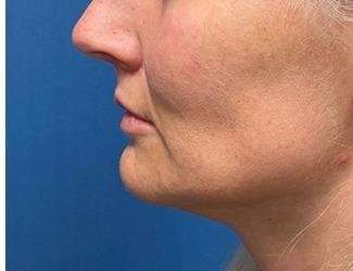 Lip Lift Before & After Patient #1289